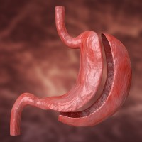 أغذية جراحة السمنة